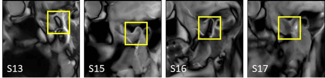 Figure 3 for Extraction of 3D trajectories of mandibular condyles from 2D real-time MRI