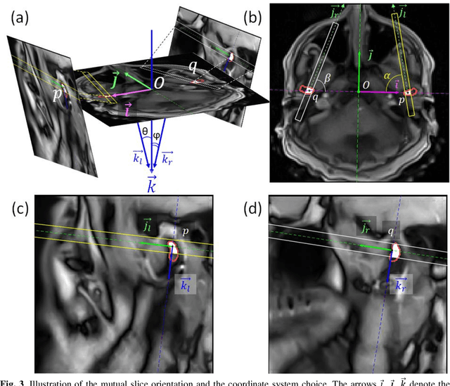 Figure 4 for Extraction of 3D trajectories of mandibular condyles from 2D real-time MRI