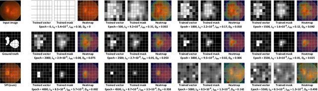 Figure 3 for Hierarchical Salient Patch Identification for Interpretable Fundus Disease Localization
