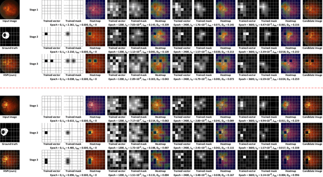 Figure 4 for Hierarchical Salient Patch Identification for Interpretable Fundus Disease Localization
