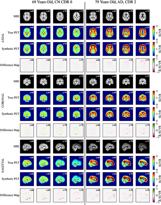 Figure 2 for Three-Dimensional Amyloid-Beta PET Synthesis from Structural MRI with Conditional Generative Adversarial Networks