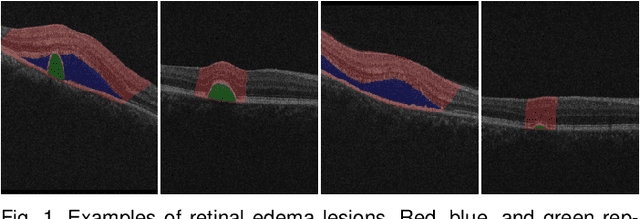 Figure 1 for Reliable Joint Segmentation of Retinal Edema Lesions in OCT Images