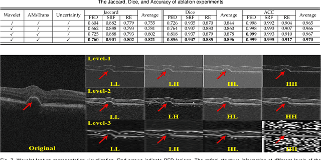 Figure 4 for Reliable Joint Segmentation of Retinal Edema Lesions in OCT Images