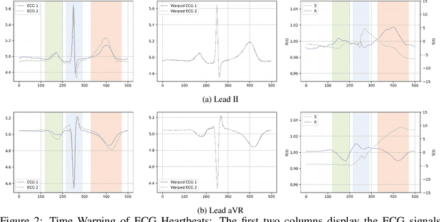 Figure 2 for Bilateral Signal Warping for Left Ventricular Hypertrophy Diagnosis