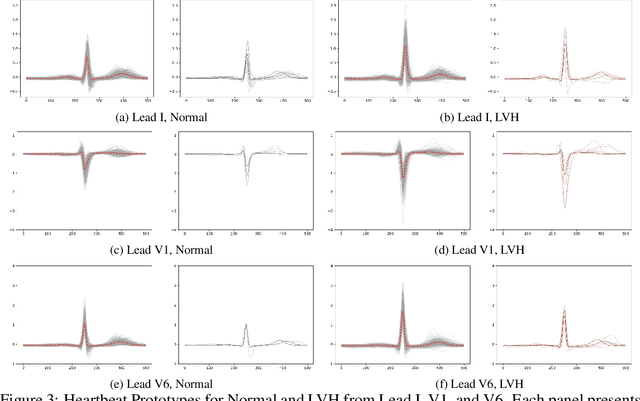 Figure 3 for Bilateral Signal Warping for Left Ventricular Hypertrophy Diagnosis