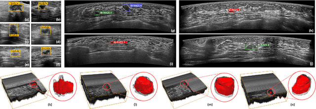 Figure 1 for Flip Learning: Weakly Supervised Erase to Segment Nodules in Breast Ultrasound