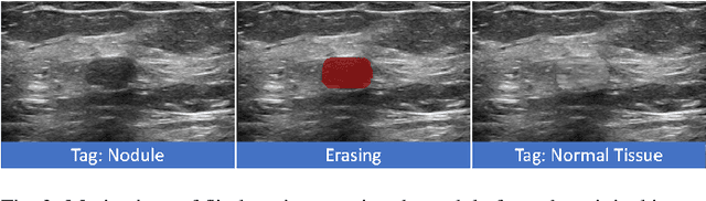 Figure 3 for Flip Learning: Weakly Supervised Erase to Segment Nodules in Breast Ultrasound