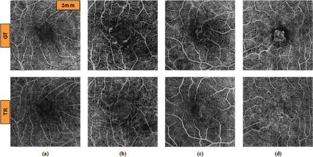 Figure 3 for Quantitative Characterization of Retinal Features in Translated OCTA
