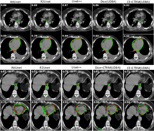 Figure 3 for Uncertainty Driven Bottleneck Attention U-net for OAR Segmentation