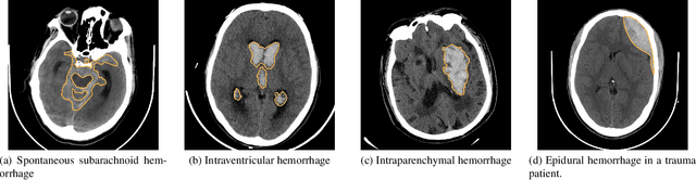 Figure 3 for Federated Voxel Scene Graph for Intracranial Hemorrhage