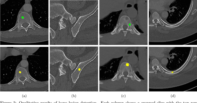 Figure 3 for Weakly-Supervised Detection of Bone Lesions in CT