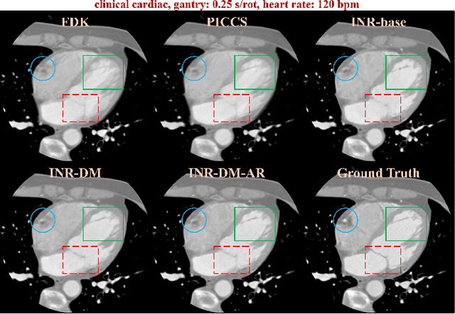 Figure 2 for Nonperiodic dynamic CT reconstruction using backward-warping INR with regularization of diffeomorphism (BIRD)