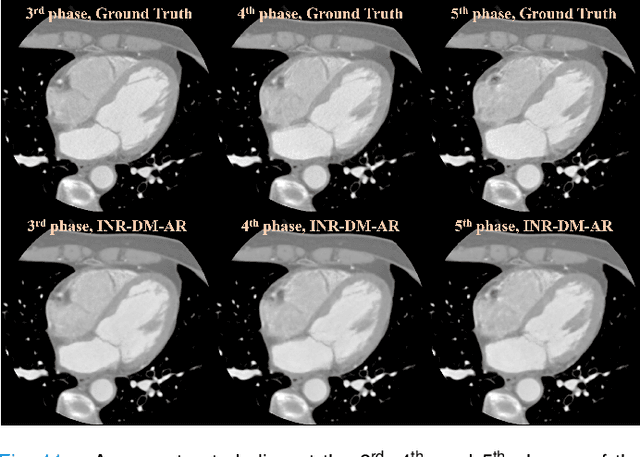 Figure 3 for Nonperiodic dynamic CT reconstruction using backward-warping INR with regularization of diffeomorphism (BIRD)
