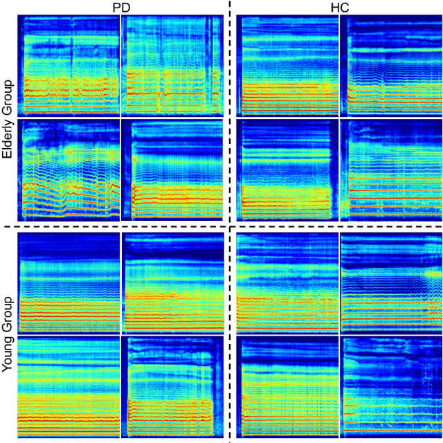 Figure 3 for Beyond Fairness: Age-Harmless Parkinson's Detection via Voice