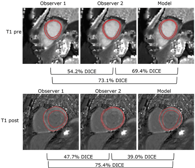 Figure 4 for Deep learning-based segmentation of T1 and T2 cardiac MRI maps for automated disease detection