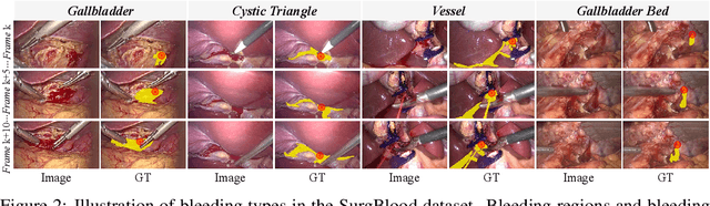 Figure 2 for Synergistic Bleeding Region and Point Detection in Surgical Videos