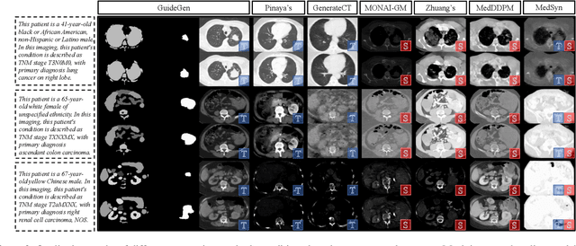 Figure 4 for GuideGen: A Text-guided Framework for Joint CT Volume and Anatomical structure Generation