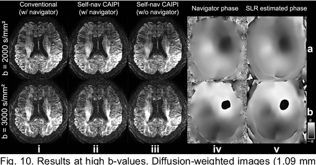 Figure 2 for Self-navigated 3D diffusion MRI using an optimized CAIPI sampling and structured low-rank reconstruction