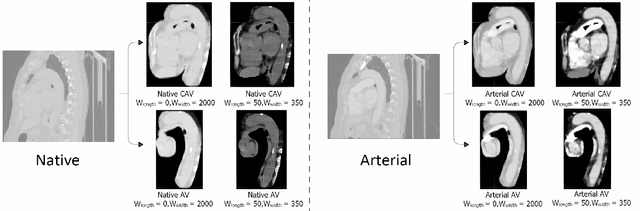 Figure 3 for Generating Synthetic Contrast-Enhanced Chest CT Images from Non-Contrast Scans Using Slice-Consistent Brownian Bridge Diffusion Network