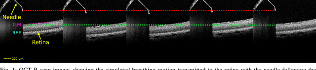 Figure 1 for Towards Motion Compensation in Autonomous Robotic Subretinal Injections