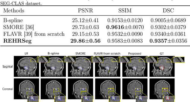 Figure 4 for REHRSeg: Unleashing the Power of Self-Supervised Super-Resolution for Resource-Efficient 3D MRI Segmentation