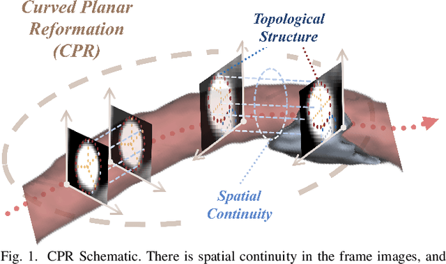 Figure 1 for An Intra- and Cross-frame Topological Consistency Scheme for Semi-supervised Atherosclerotic Coronary Plaque Segmentation