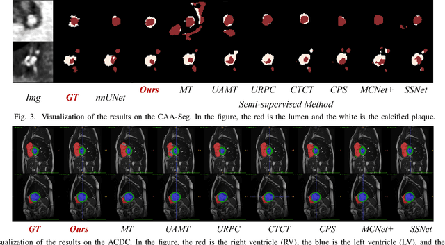 Figure 3 for An Intra- and Cross-frame Topological Consistency Scheme for Semi-supervised Atherosclerotic Coronary Plaque Segmentation