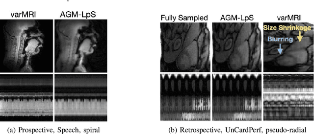 Figure 4 for Few Shot Alternating GD and Minimization for Generalizable Real-Time MRI