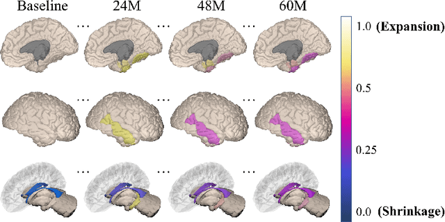 Figure 1 for Deep Geometric Learning with Monotonicity Constraints for Alzheimer's Disease Progression