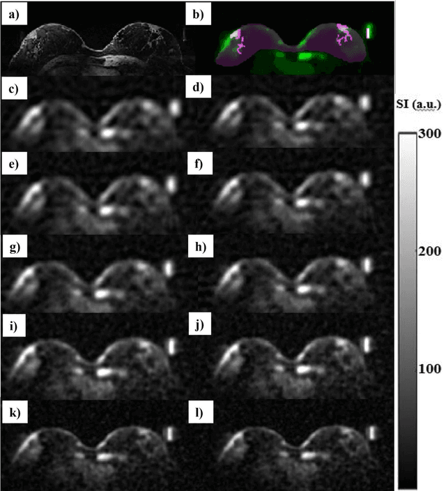 Figure 2 for Improved tissue sodium concentration quantification in breast cancer by reducing partial volume effects: a preliminary study