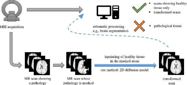 Figure 1 for Denoising Diffusion Models for Inpainting of Healthy Brain Tissue