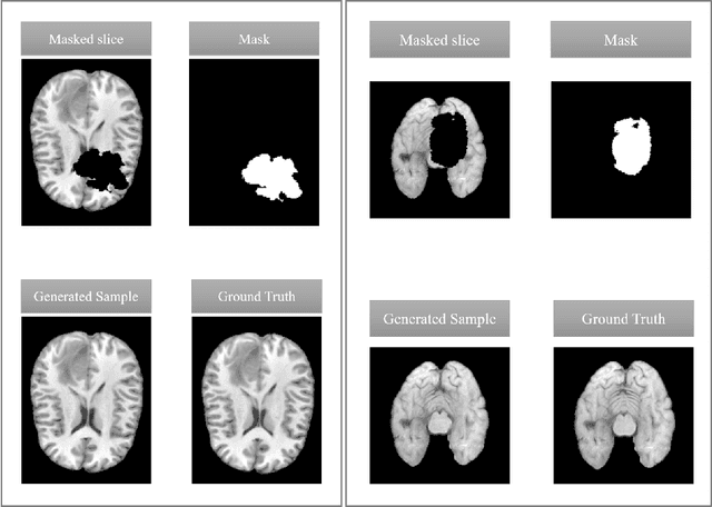 Figure 4 for Denoising Diffusion Models for Inpainting of Healthy Brain Tissue