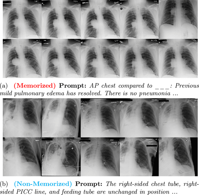 Figure 1 for The Devil is in the Prompts: De-Identification Traces Enhance Memorization Risks in Synthetic Chest X-Ray Generation