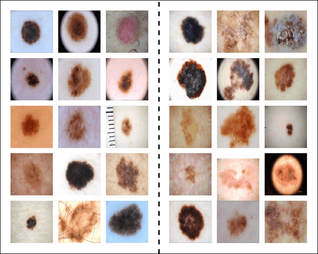 Figure 4 for Hybrid Interpretable Deep Learning Framework for Skin Cancer Diagnosis: Integrating Radial Basis Function Networks with Explainable AI