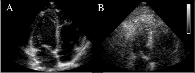 Figure 1 for Dehazing Ultrasound using Diffusion Models