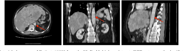 Figure 4 for Efficient 2D CT Foundation Model for Contrast Phase Classification