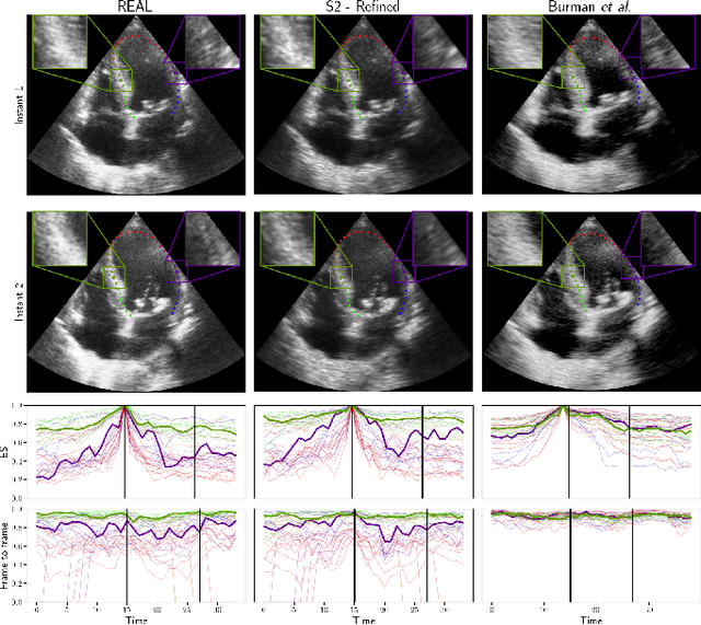 Figure 4 for Generation of realistic cardiac ultrasound sequences with ground truth motion and speckle decorrelation