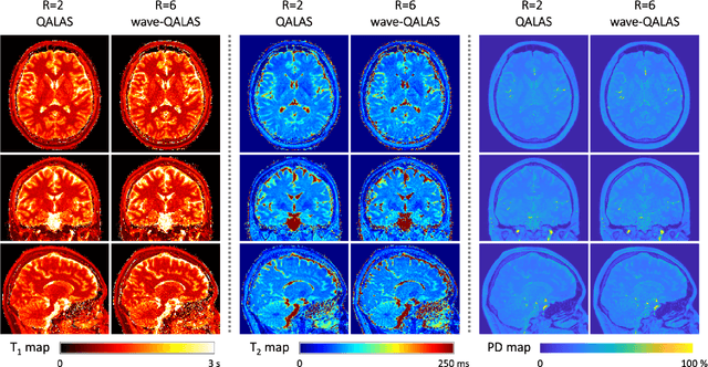 Figure 3 for Time-efficient, High Resolution 3T Whole Brain Quantitative Relaxometry using 3D-QALAS with Wave-CAIPI Readouts