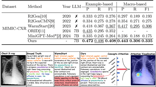 Figure 3 for MCA-RG: Enhancing LLMs with Medical Concept Alignment for Radiology Report Generation