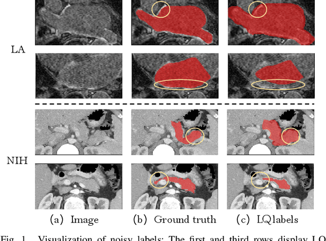 Figure 1 for Adaptive Label Correction for Robust Medical Image Segmentation with Noisy Labels