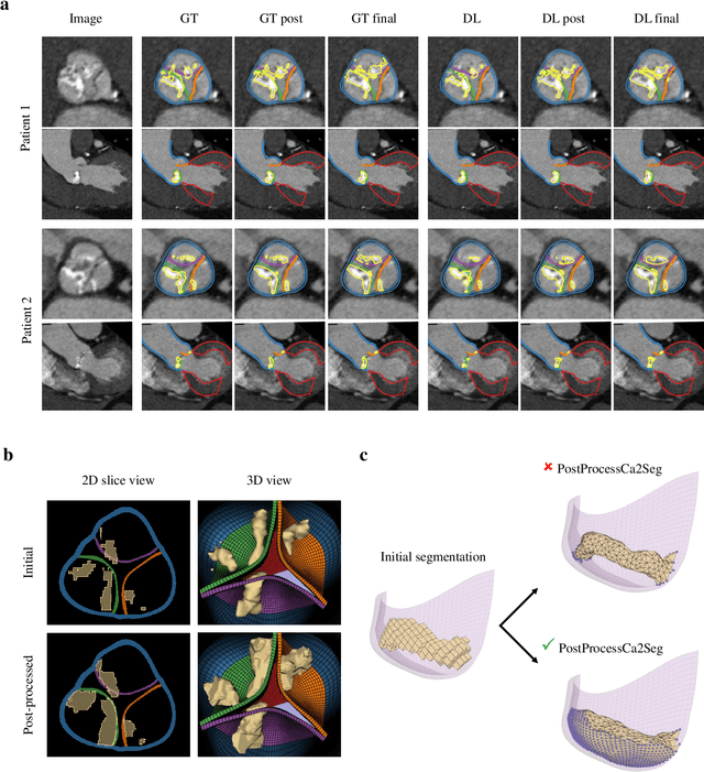 Figure 3 for Robust automated calcification meshing for biomechanical cardiac digital twins