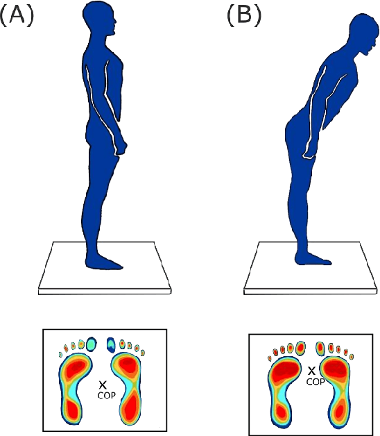 Figure 1 for The Required Spatial Resolution to Assess Imbalance using Plantar Pressure Mapping