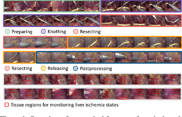 Figure 1 for Surgical Workflow Recognition and Blocking Effectiveness Detection in Laparoscopic Liver Resections with Pringle Maneuver