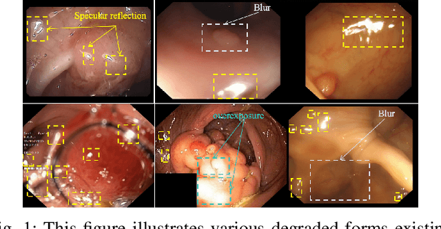 Figure 1 for AgentPolyp: Accurate Polyp Segmentation via Image Enhancement Agent