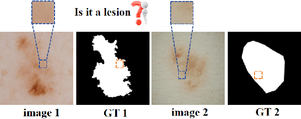 Figure 3 for Multi-Granularity Vision Fastformer with Fusion Mechanism for Skin Lesion Segmentation