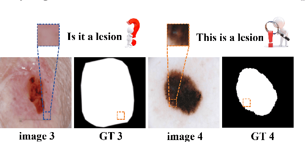 Figure 4 for Multi-Granularity Vision Fastformer with Fusion Mechanism for Skin Lesion Segmentation