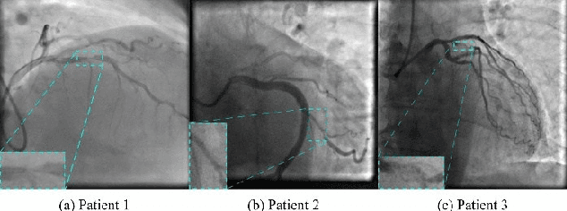 Figure 4 for Object Detection for Automated Coronary Artery Using Deep Learning