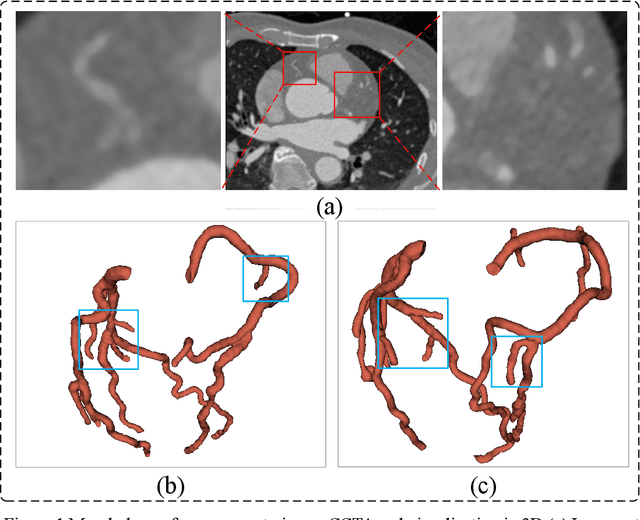 Figure 1 for Myocardial Region-guided Feature Aggregation Net for Automatic Coronary artery Segmentation and Stenosis Assessment using Coronary Computed Tomography Angiography
