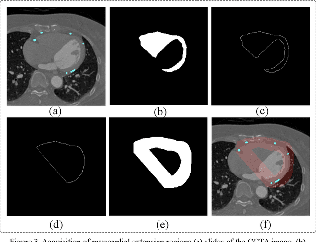 Figure 3 for Myocardial Region-guided Feature Aggregation Net for Automatic Coronary artery Segmentation and Stenosis Assessment using Coronary Computed Tomography Angiography