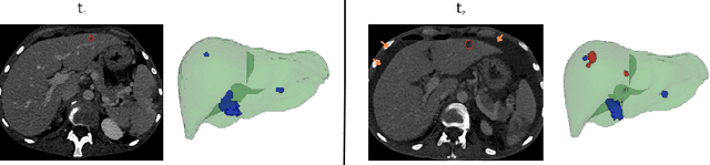 Figure 1 for Registration of Longitudinal Liver Examinations for Tumor Progress Assessment